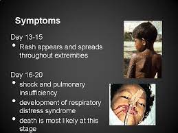 Early signs and symptoms include: Ebola Hemorrhagic Fever Jessie Nipp Kristen Rhodin Frank