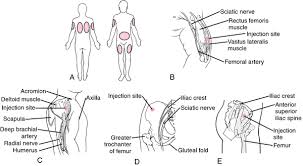 Image result for Subcutaneous Injection