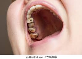 What are the symptoms of a rotten tooth? Rotten Teeth Woman Stock Photo Edit Now 773283970