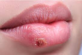 #herpes #hsv #hsv 1 #hsv 2 #sti #sexually transmitted disease #sexually transmitted infection #stis. Cold Sores Online Treatment Herpes Simplex 1 Treatment Herp Alert