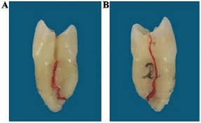Image result for Tooth Fracture