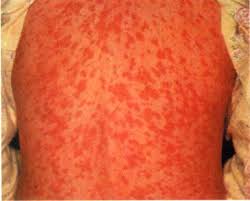 Image result for Generalized Rash