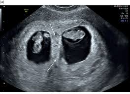With aws lambda, you can run code without provisioning or managing servers. Sonographic Assessment Of Early Pregnancy Chapter 14 Gynaecological Ultrasound Scanning