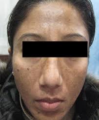Photograph of a patient of group A before the treatment.