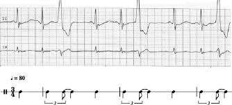 An electrocardiogram (ecg) may be done. Ecg And Transcription Of A Trigeminy Rhythm Ecg Of Trigeminal Download Scientific Diagram
