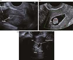 We did not find results for: Ultrasound Imaging Of Women With Abnormal Uterine Bleeding Aub Chapter 13 Ultrasound In Reproductive Healthcare Practice