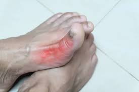 Image result for gout symptoms toe
