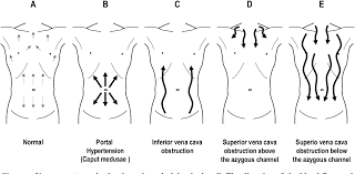 Pdf A Prompt Diagnosis Of Superior Vena Cava Obstruction Established By Physical Examination Semantic Scholar