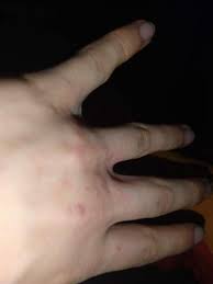Hautausschlag An Der Hand Mit Juckreiz Gesundheit Und Medizin Gesundheit Haut