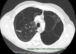 Pneumothorax, condition in which air accumulates in the pleural sac, causing it to expand and compress the underlying lung, which may then collapse. Blebs Bullae And Spontaneous Pneumothorax Thoracic Surgery