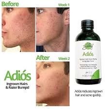 Explore a wide range of the best hair serum on besides good quality brands, you'll also find plenty of discounts when you shop for hair serum during big sales. Adios Ingrown Hair Razor Bump Tonic By Shelley Skin Care Humble Bee Beauty Studio