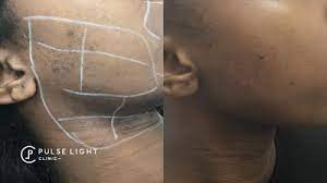 The light energy is therefore absorbed by the hairs, unless they are fair also. Laser Hair Removal Dark Skin Pulse Light Clinic London