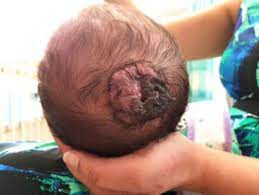 In this article, we'll define necrotic tissue and describe ways to effect its removal from the wound bed. Necrosis Of Infantile Haemangioma With Propranolol Therapy Archives Of Disease In Childhood