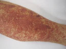 Maybe you would like to learn more about one of these? Cutaneous Small Vessel Vasculitis Wikipedia