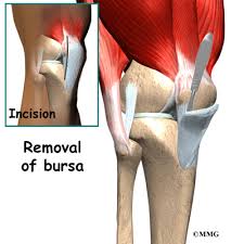 Bursa büyükşehir belediyesi tarafından mustafakemalpaşa'nın doğancı mahallesi'ne kazandırılan mahalle konağı inşaatında çalışmalar hızlandı. Prepatellar Bursitis Orthogate