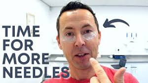 NICK GETS A NEW EYE TREATMENT FOR EYEBAGS AT MID YORKSHIRE SKIN CLINIC