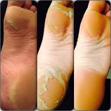 After you exfoliate your feet, rinse clean, then dry and apply a thick layer of foot cream. Baby Foot Peel Will Transform Calluses Cracked Feet