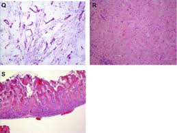 Maybe you would like to learn more about one of these? Euracan Iaslc Proposals For Updating The Histologic Classification Of Pleural Mesothelioma Towards A More Multidisciplinary Approach Journal Of Thoracic Oncology