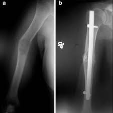 + add or change photo on imdbpro ». Pdf Minimally Invasive Treatment Of Pathological Fractures Of The Humeral Shaft