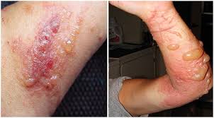Image result for Rhus Dermatitis