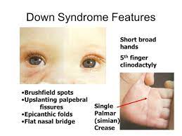 10 things to know about epicanthal fold 10 zap. Brush Field Spots White Or Grey Spot In The Periphery Of The Iris Medical Knowledge Epicanthic Fold Down Syndrome Features
