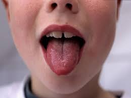 Image result for Scarlet Fever