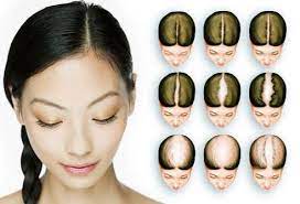 In order to do that, we need a few things. 5 Types Of Hair Loss Patterns In Females And Reversible Treatment Bee Choo Ladies