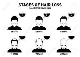 If your hair loss occurs in a more regular receding pattern, usually from the temples and crown of the head, then it is more likely you have male. Hair Loss Stages And Types Of Male Hair Loss Male Pattern Baldness Royalty Free Cliparts Vectors And Stock Illustration Image 103240063