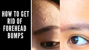 An example of a home remedy is to apply a warm compress to the forehead twice daily, which can help remove excess sebum and improve recovery. How To Get Rid Of Forehead Bumps Youtube