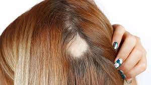 Lichtes Haar Schnelle Und Dauerhafte Hilfe Bei Haarausfall Augsburger Allgemeine
