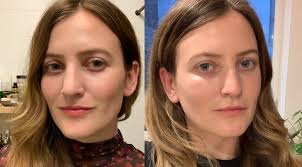 Definitive guide on cheek augmentation with fillers, including the procedure overview, benefits, risks, recovery, before & after photos, costs, and more. What To Know Before Getting Undereye Fillers Popsugar Beauty