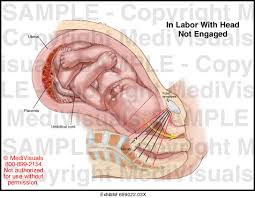 In Labor With Head Not Engaged Medical Exhibit Medivisuals