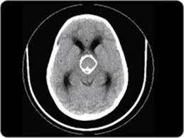 A small amount of a radioactive substance is. Computerized Tomography Ct Scan For Brain Tumours
