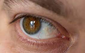 The lining outside your eyeball and inside your eyelid is called the conjunctiva. Eye Tumors Symptoms Causes Diagnosis Treatment