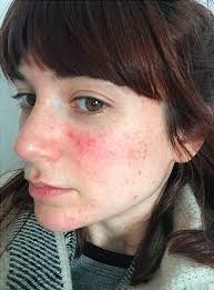 Why I risked my mental health for an acne cure by taking Roaccutane
