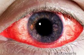 Image result for Vernal Conjunctivitis