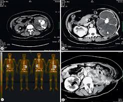 Image result for Nephrolithiasis Imaging
