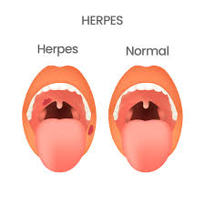 Image result for oral herpes symptoms roof of the mouth