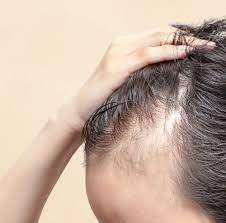 Alopecia Areata Treatment in Mumbai