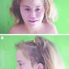 A, B) Clinical pictures of the patient. Parental informed consent was...