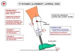 Transtibial Dynamic Alignment In 2020 Alignment Nursing School Notes Prosthetics