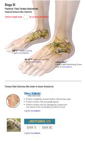 Pin On Posterior Tibial Tendon Dysfunction Pttd