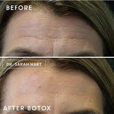 In clinical studies, physicians assessed 74% of adults had improvement at day 7, subjects assessed 82% had at least moderate improvement. Gallery Before And After Photos By Dr Sarah Hart