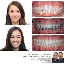 What are the 5 determinants of decision making of gummy smile cases. Gummy Smile Transformation Frost Orthodontics Facebook