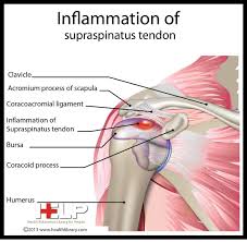 Supraspinatus tendon fans out, intermingling with the fibers of the infraspinatus and subscapularis. Pin On Skeletal