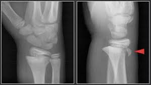 Maybe you would like to learn more about one of these? Distal Radius Fractures Pediatric Pediatrics Orthobullets