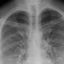 Bacterial, viral, and fungal infections can all cause pneumonia. Pneumonia What Are The Symptoms And Who Is At Risk Health The Guardian