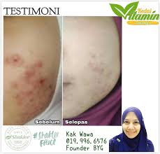 Ziela terangkan 4 sebab kenapa vitamin c shaklee patut jadi. Sebulan Makan Vitamin C Jerawat Kurang Kulit Lembut Vitamin Wawa Pengedar Shaklee Aktif