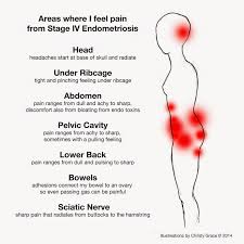 Art Of Christy Grace Endometriosis Pain Blog About My Experiences With Endo So Far With Illustrations Endo Pinterest Salud Dolores De Cabeza Y Medi