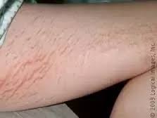 Cleansing your thighs cleansing is the best place to start when wanting to eradicate these unsightly inner thigh blackheads. How To Get Rid Of Red Stretch Marks On My Inner Thighs Quora